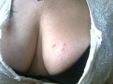 le mie bruciature dopo un incontro....